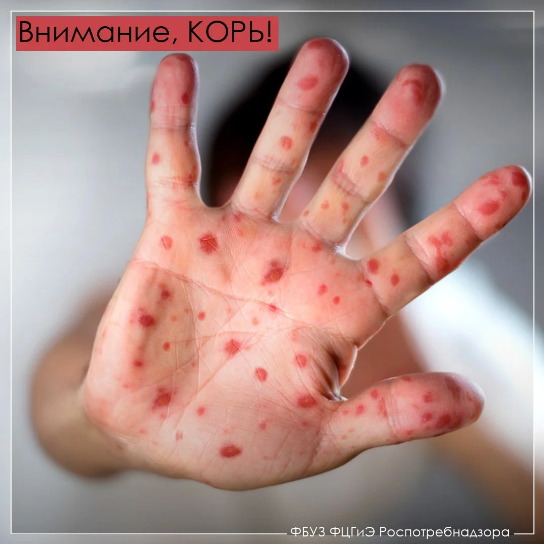 Внимание! Корь